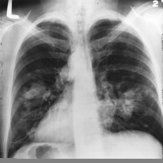 An x-ray of lungs with lung cancer.