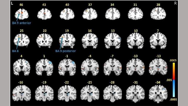 White and black brain scans