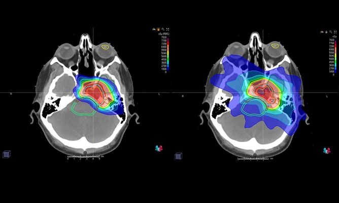 proton therapy brain scan