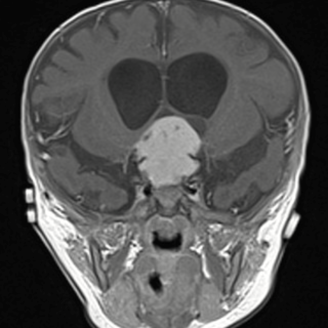 scan of a glioma